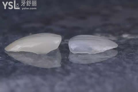 牙齒貼面的分類？