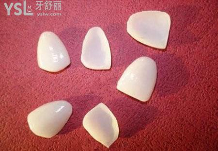 醫(yī)生建議做烤瓷牙貼面要謹(jǐn)慎？
