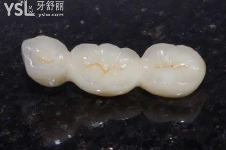 氧化鋯烤瓷牙的特點(diǎn)？