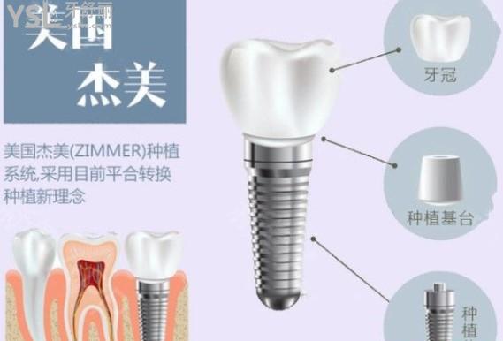 美國(guó)zimmer（杰美）種植體