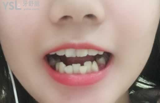 二十歲矯正牙齒后悔，只要去正規(guī)的口腔醫(yī)院就不會給你后悔的機會