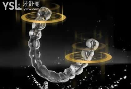 時代天使隱形矯正器五大優(yōu)點