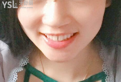 戴牙套一個(gè)月不想戴了，矯正的結(jié)果是值得你堅(jiān)持下去的，加油。