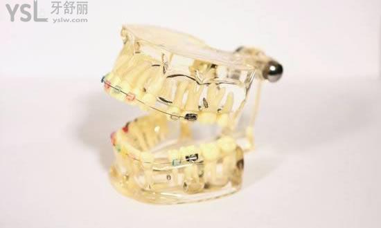 廈門峰煜口腔特色牙齒矯正技術