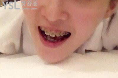 20歲整牙還來得及嗎，有想法的時(shí)候立馬行動到時(shí)候你會感謝我的