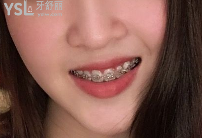 20歲整牙還來得及嗎，有想法的時(shí)候立馬行動到時(shí)候你會感謝我的