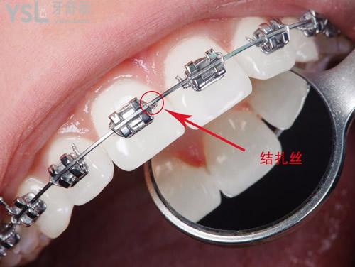 陶瓷矯正器和金屬矯正器哪個更好?