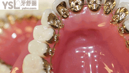 陶瓷矯正器和金屬矯正器那個更好？