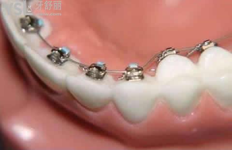 陶瓷矯正的優(yōu)勢：