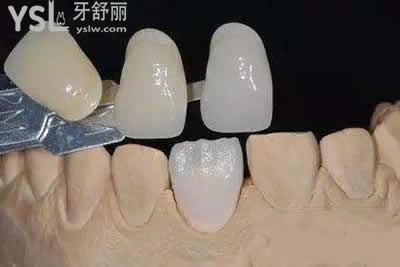 為什么有的人做了牙貼面會后悔？