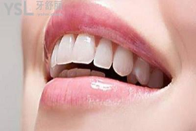 全瓷貼面的特點：