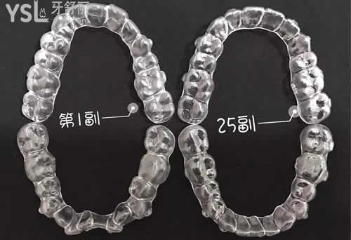 為什越來越多人選擇隱形矯正？