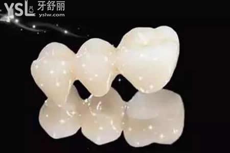 全瓷牙主要分為哪幾種？