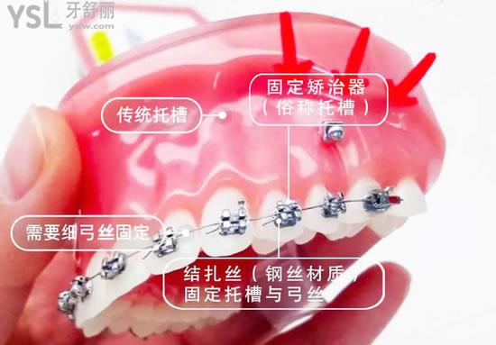 牙套的種類和價(jià)格曝光，精選剖析牙套哪種材料的比較好?