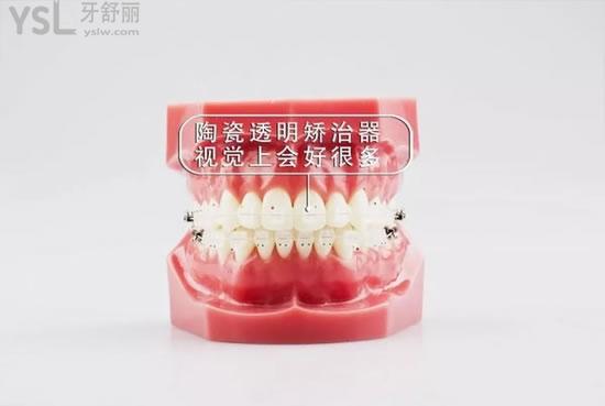 牙套的種類和價(jià)格曝光，精選剖析牙套哪種材料的比較好?