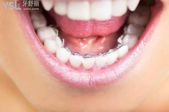 舌側(cè)矯正牙套.jpg