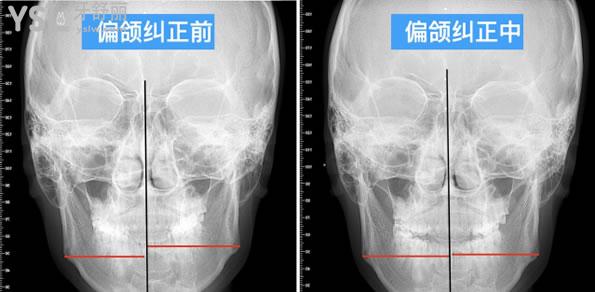矯正1 (1).jpg