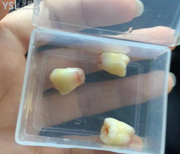 拔智齒后悔死了是真的嗎，拔智齒會很疼嗎？