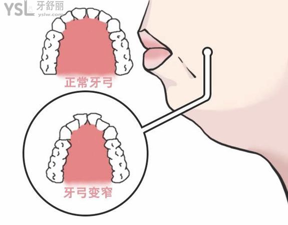 擴(kuò)弓會(huì)不會(huì)讓臉變大？