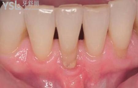 牙周炎發(fā)生后幾天能好嗎