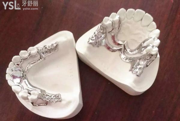 金屬材質(zhì)假牙