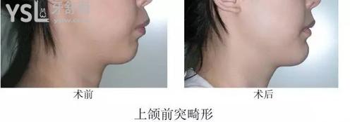 天包地要怎么矯正3