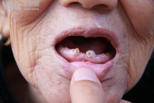 你問(wèn)我答：牙齒缺失久了還能種植嗎（牙齒缺失10年了還可以修復(fù)嗎）