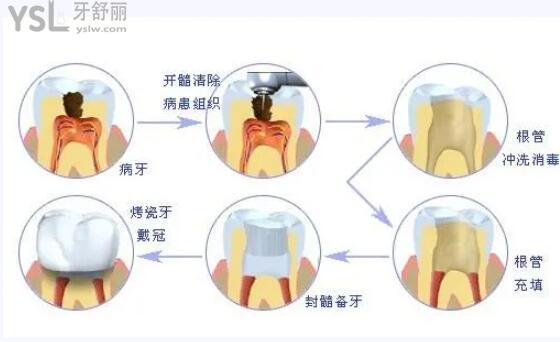 根管治療的過(guò)程