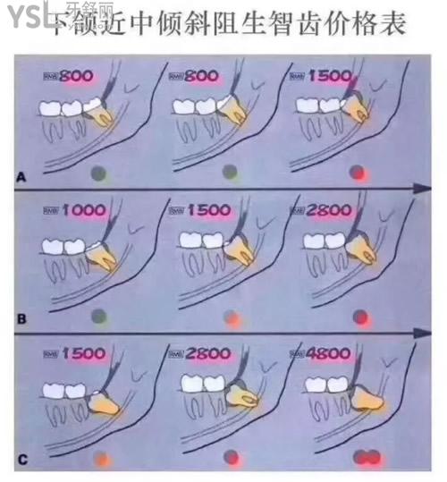 智齒拔除價(jià)格表