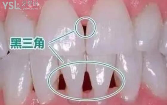牙齒黑三角
