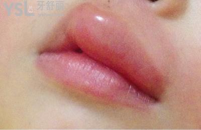 我裂開(kāi)了，嘴突然腫了是什么原因？