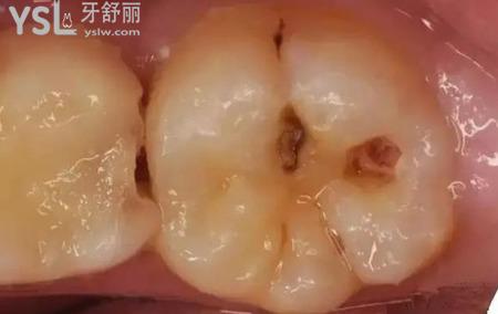 如果牙齒有洞怎么辦