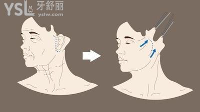 拉皮手術怎么樣