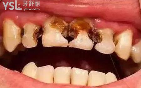 爛牙痛應(yīng)該怎么快速止痛？