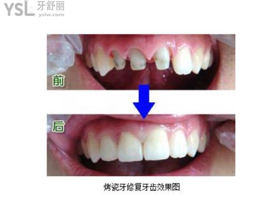 烤瓷牙修復(fù)前后對比圖