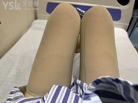 大腿吸脂后