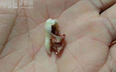爛牙根很臭要拔掉嗎？