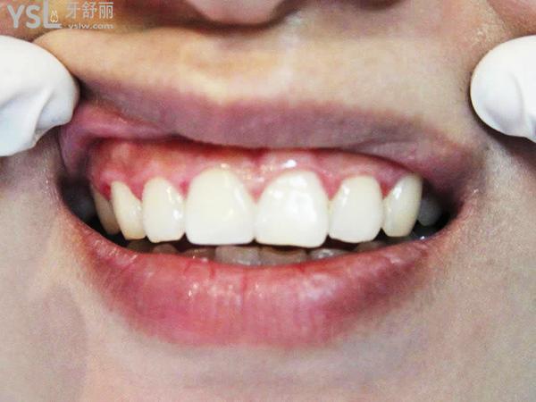 門牙掉了一塊怎么辦