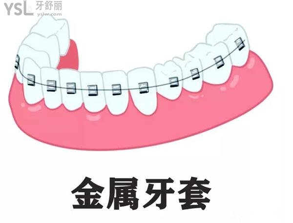金屬牙套