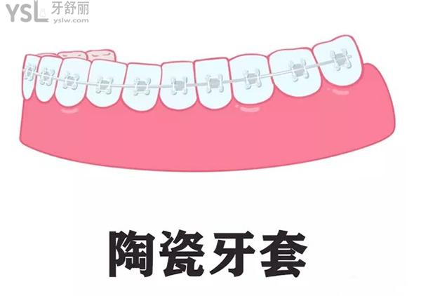 陶瓷牙套