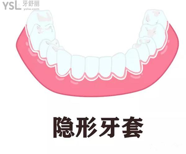 隱形牙套
