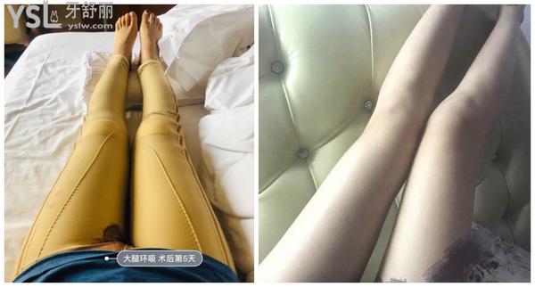 烏魯木齊黎美整形醫(yī)院怎么樣，吸脂好嗎