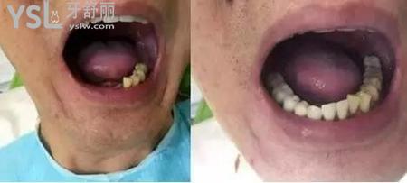 種植牙后可以吃東西嗎？