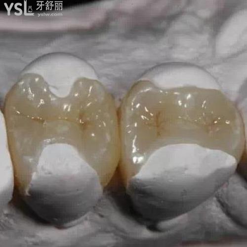 補(bǔ)牙材料哪種好？