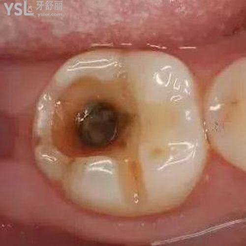 牙壞了怎么補救？