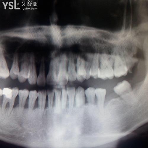 牙槽骨萎縮能不能種牙？