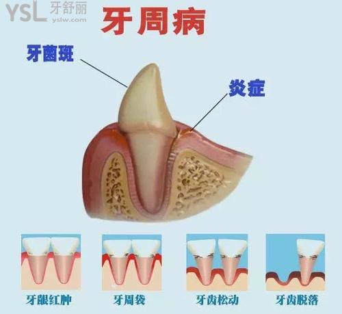牙周病導(dǎo)致老年人牙齒掉了一部分