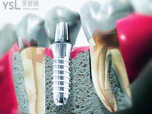 鑲牙貴的和便宜的有什么區(qū)別？過來人道出實(shí)情15.jpg