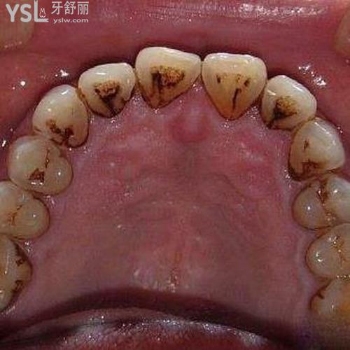 牙齒結(jié)石自己怎么弄掉？
