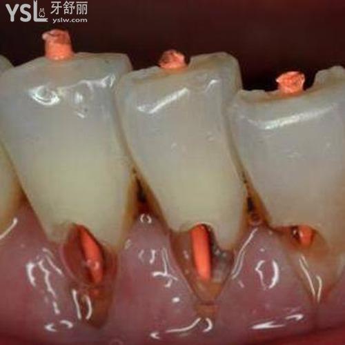牙漏神經(jīng)了怎么辦？